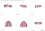 design your exocad crown accurately